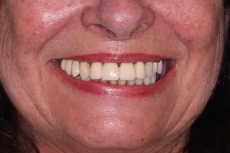 All-on-X Patient 1 before