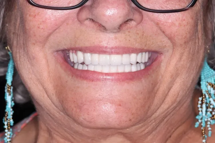 All-on-X Patient 1 after