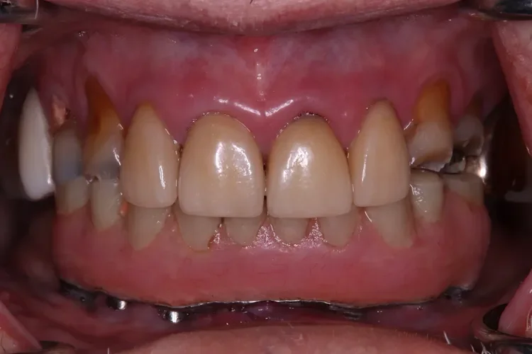 Hybrid Crown Restoration Patient 1 before