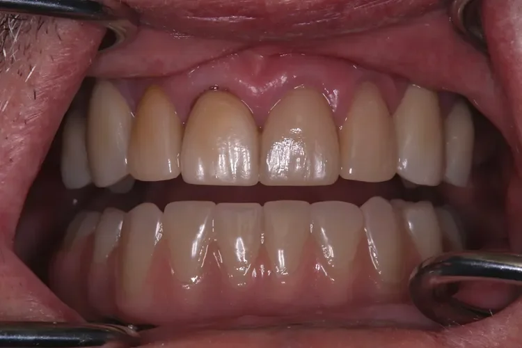 Hybrid Crown Restoration Patient 1 after