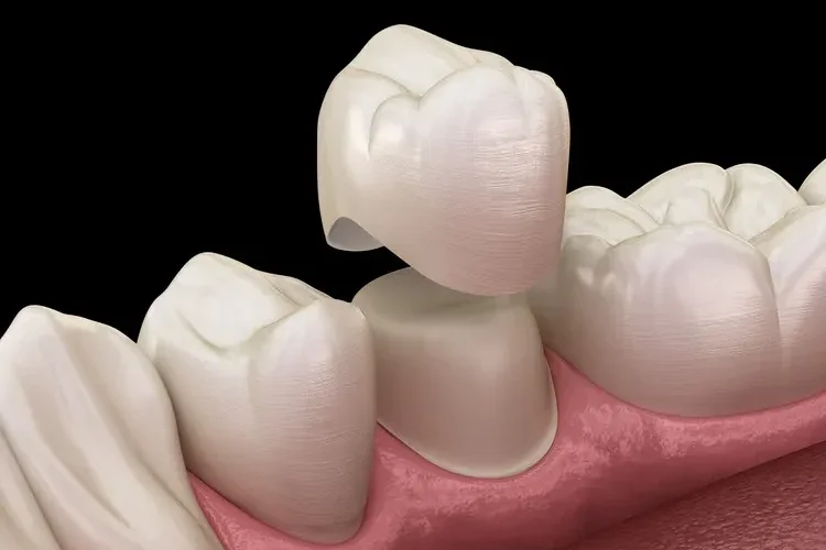 Dental Crowns Graphic