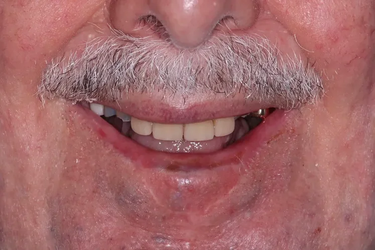 dental crown patient before