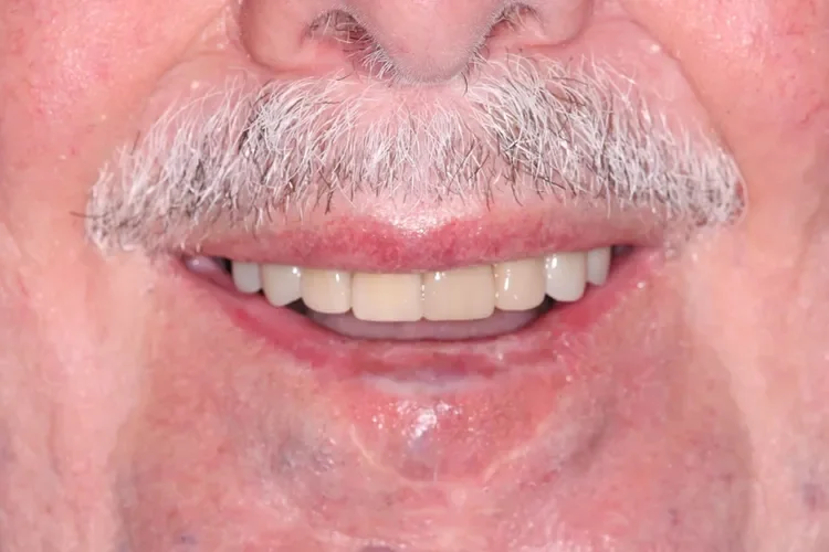 dental crown patient before
