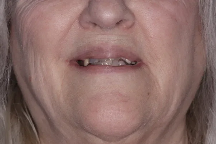 dentures patient 2 before