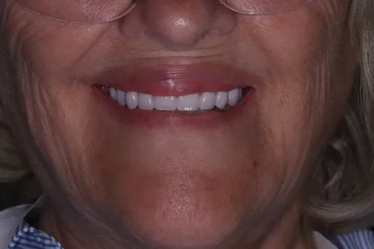 dentures patient 2 after