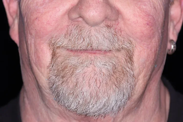 dentures patient before