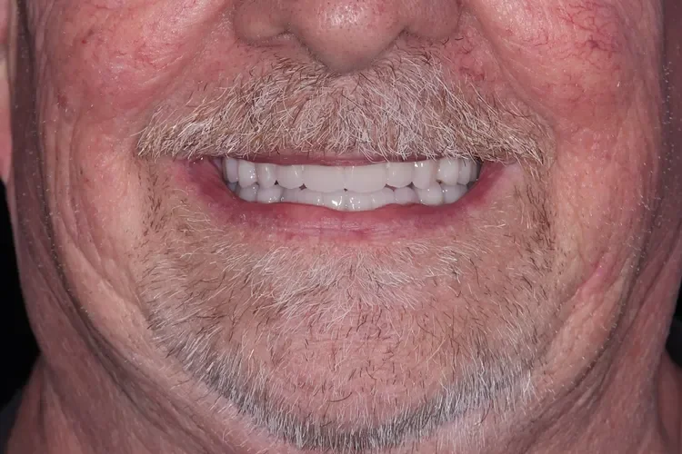 dentures patient after