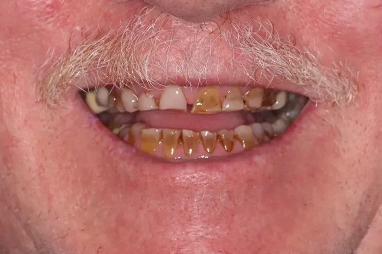 Full-Mouth Reconstruction Patient 1 before