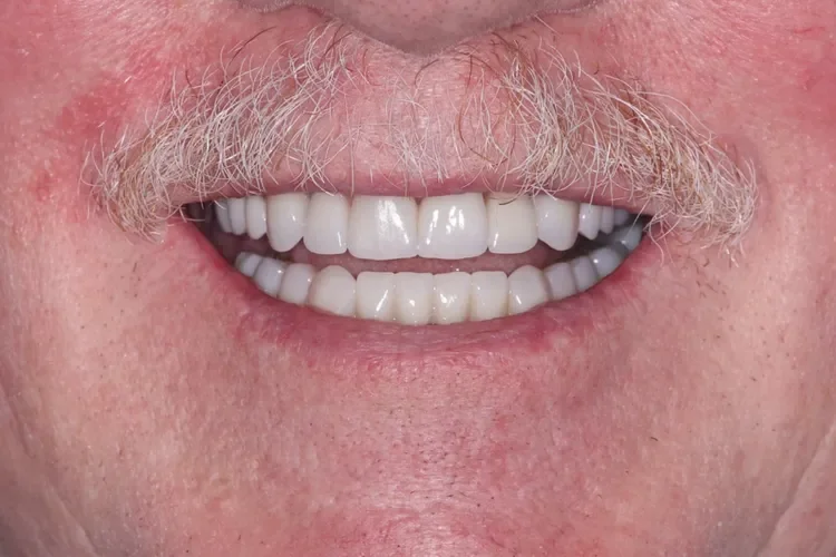 Full-Mouth Reconstruction Patient 1 after