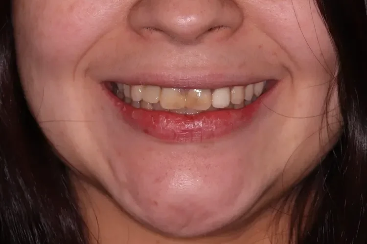 Implant Bridge and Teeth Whitening Patient 1 before