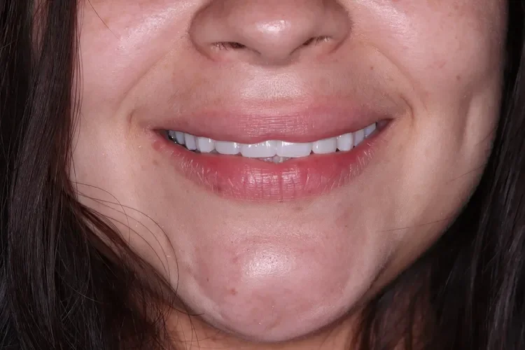 Implant Bridge and Teeth Whitening Patient 1 after