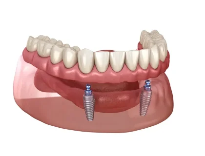 Overdentures graphic illustration