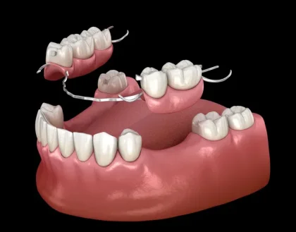 graphic illustration partial dentures in a lower jaw
