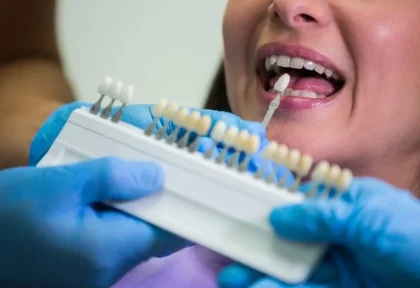 Dental Veneers sample tooth model